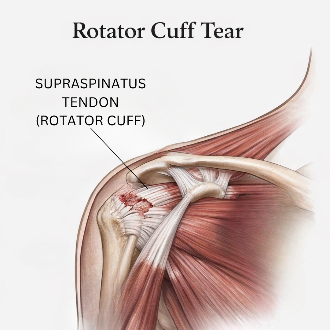 Rotator Cuff Tear