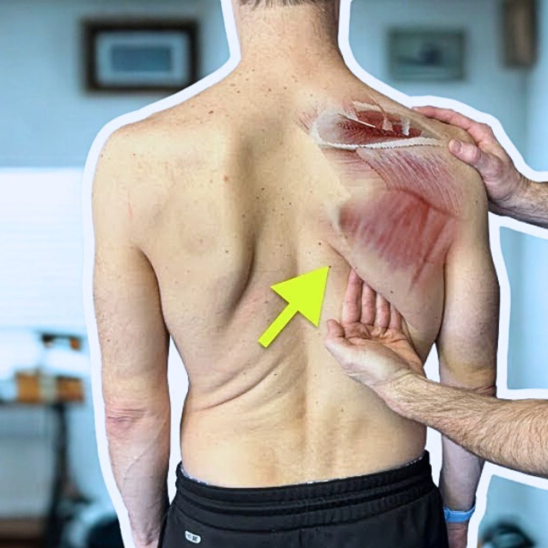 Winged scapula shoulder blade instability treatment Greenville SC