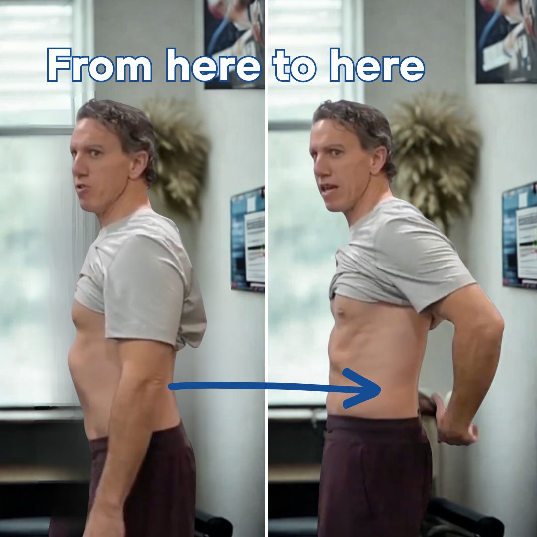 Anterior pelvic tilt correction showing before and after posture improvement