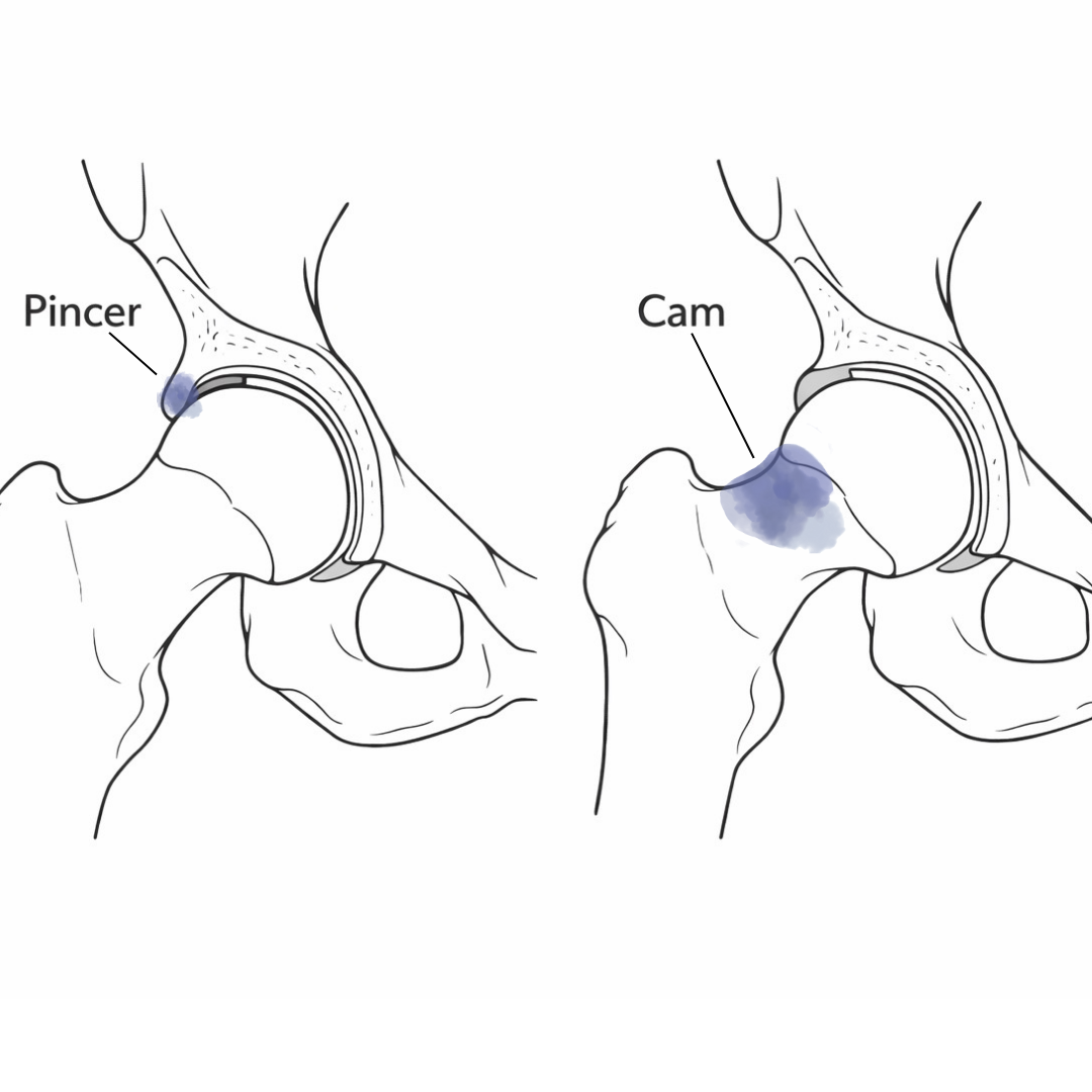 FAI femoroacetabular impingement anatomy showing cam and pincer types