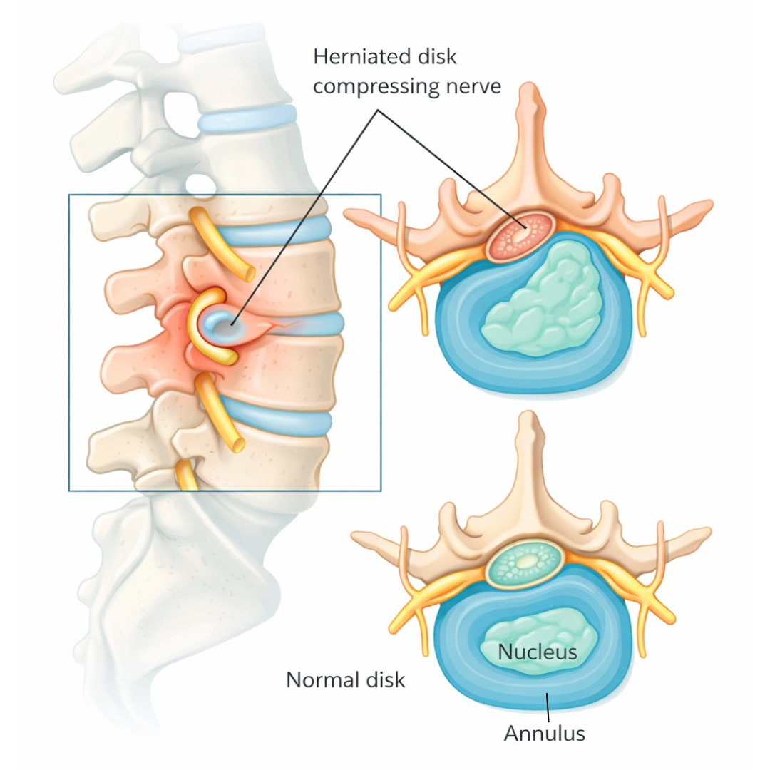 Herniated disc anatomy diagram showing nerve compression and disc bulge