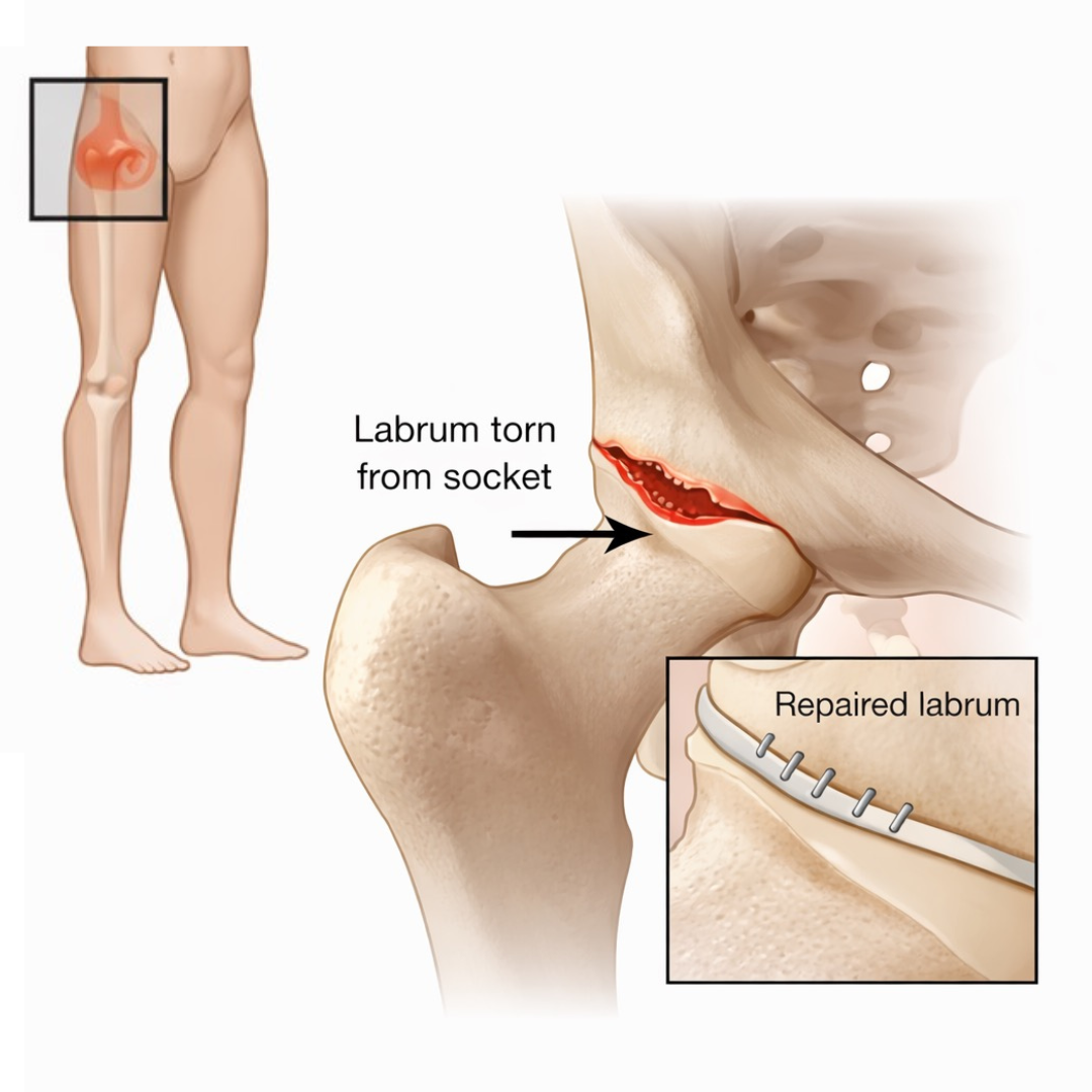 Hip labrum tear anatomy diagram showing torn and repaired labrum
